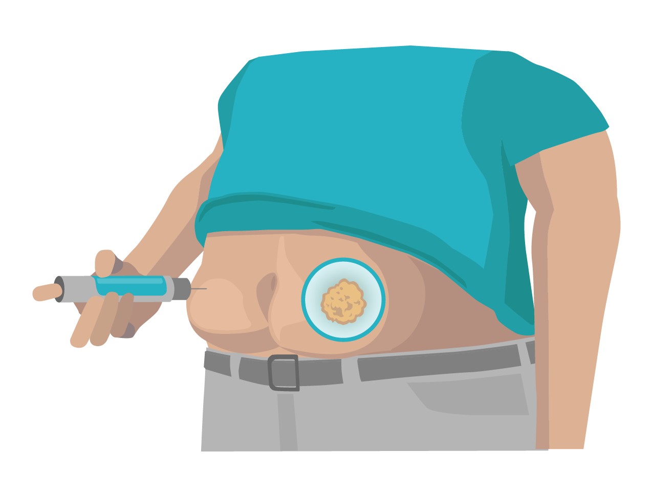 6.3.1+6.3.2 Injection on the abdomen